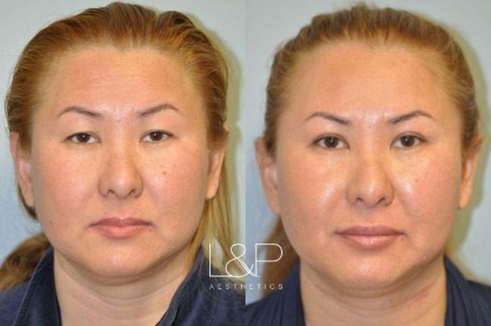 Facial Fillers Case 13 Before & After Front | Palo Alto, California | L&P Aesthetics