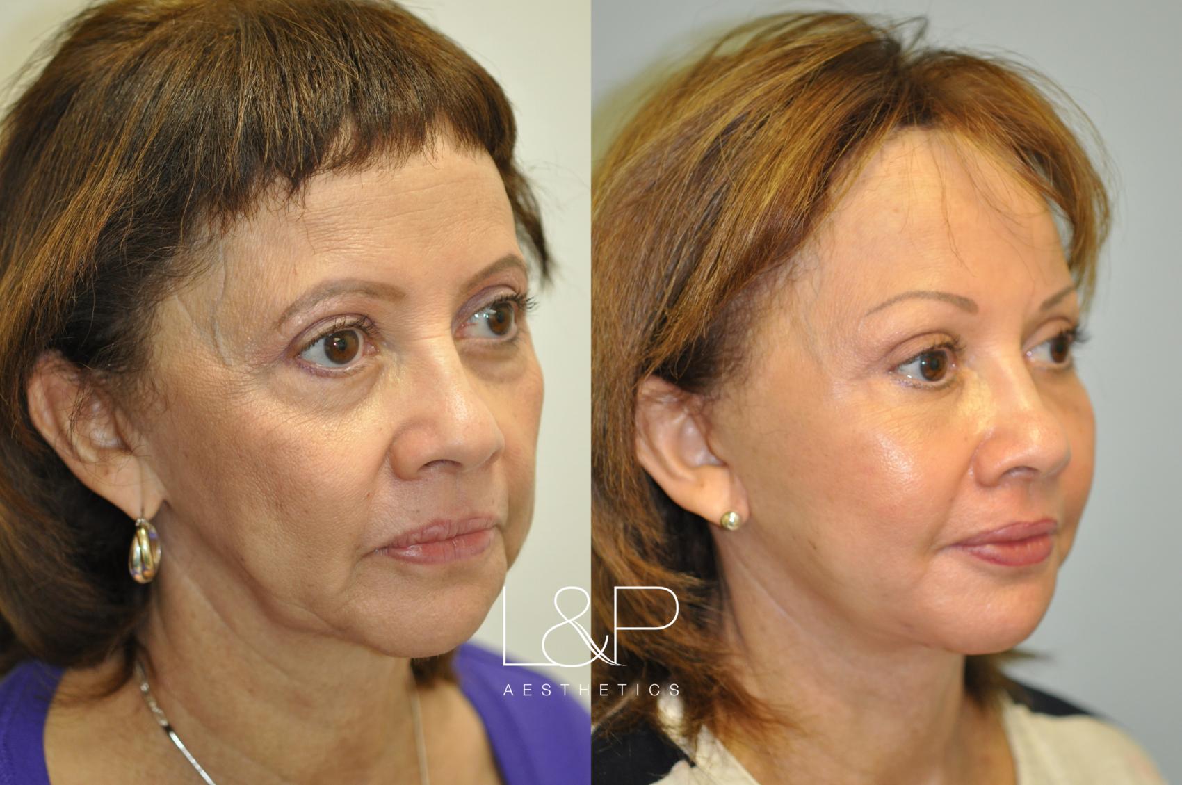 Brow Lift Before and After