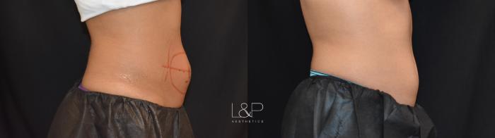 Before and After Coolsculpting