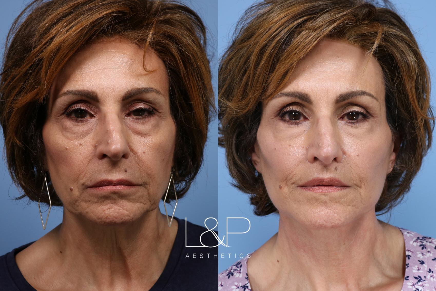 Fabulous Facelift