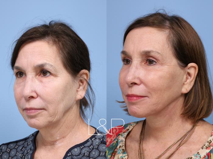 L&P Signature Facelift and Neck Lift for woman in her early 60s.