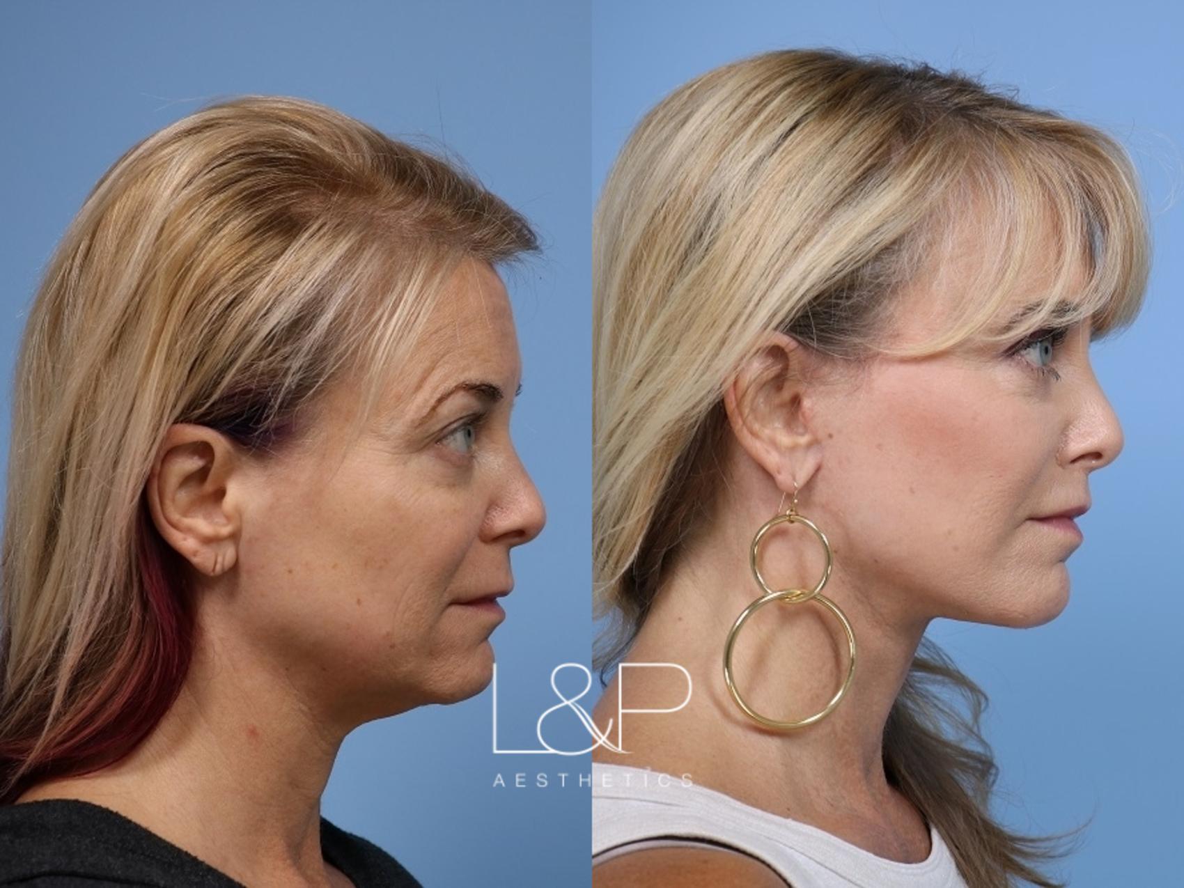 Revision Facelift for Menlo Park Woman