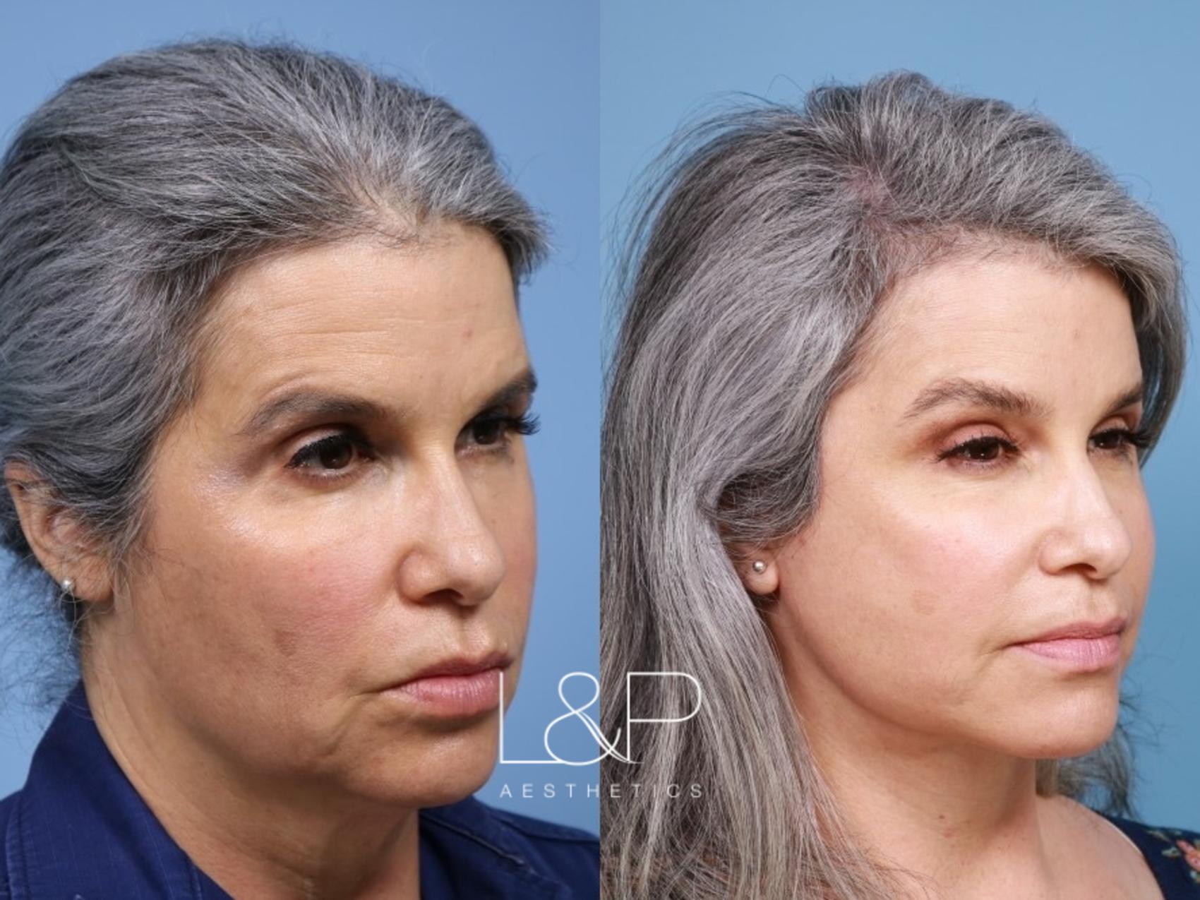 Natural Looking Facial Rejuvenation