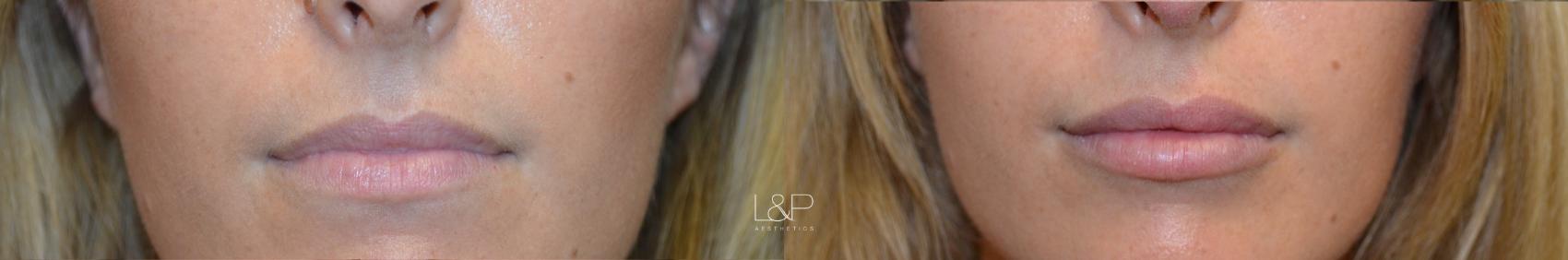 Lip Augmentation Before And After