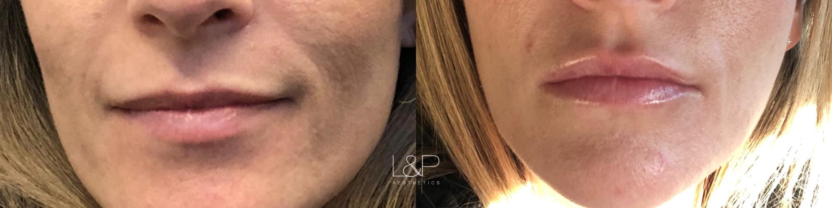 Lip Augmentation Case 139 Before & After Front | Palo Alto, California | L&P Aesthetics