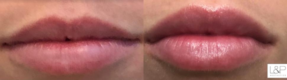 Lip Augmentation Case 88 Before & After Front | Palo Alto, California | L&P Aesthetics