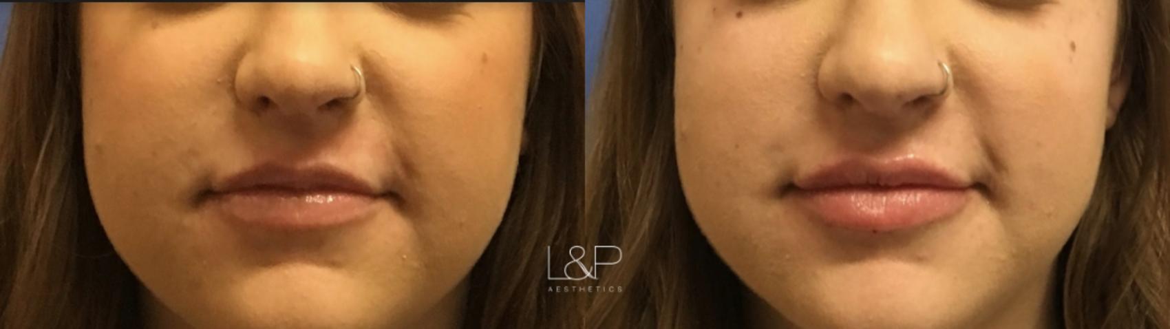 Lip Augmentation Case 94 Before & After Front | Palo Alto, California | L&P Aesthetics
