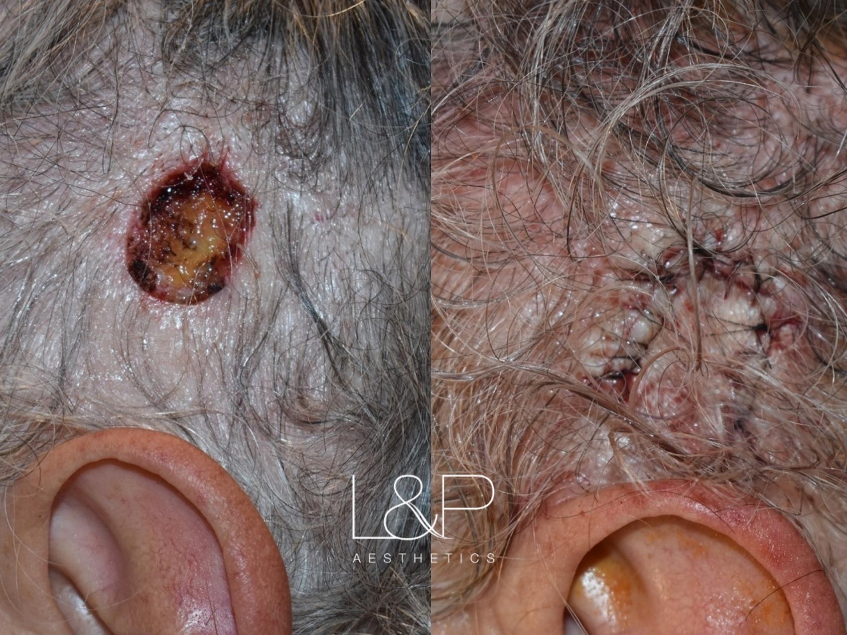 Reconstruction surgery to enclose area right above the ear.
