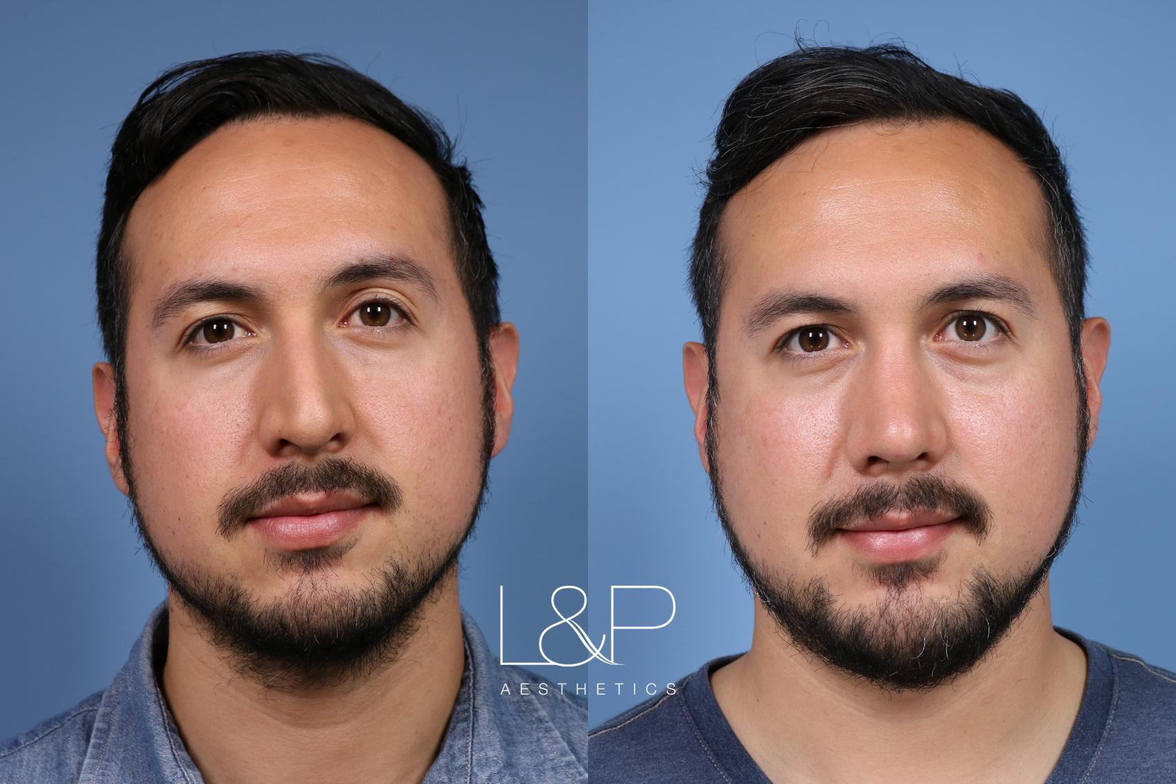 Rhinoplasty Case 162 Before & After Front | Palo Alto & San Jose, California | L&P Aesthetics