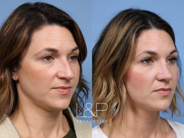 Nose surgery to bring other facial features to the forefront