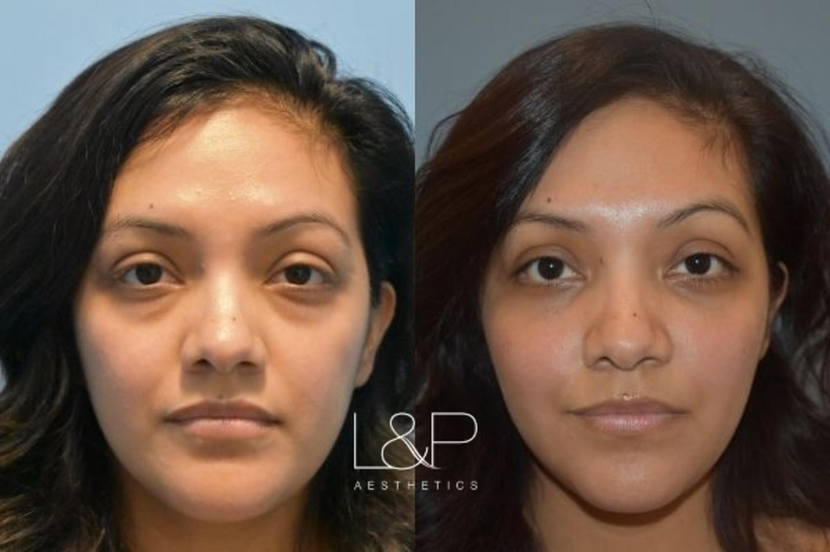 Fat Transfer Before And After Photos Case 1 Palo Alto And San Jose California Landp Aesthetics 5876