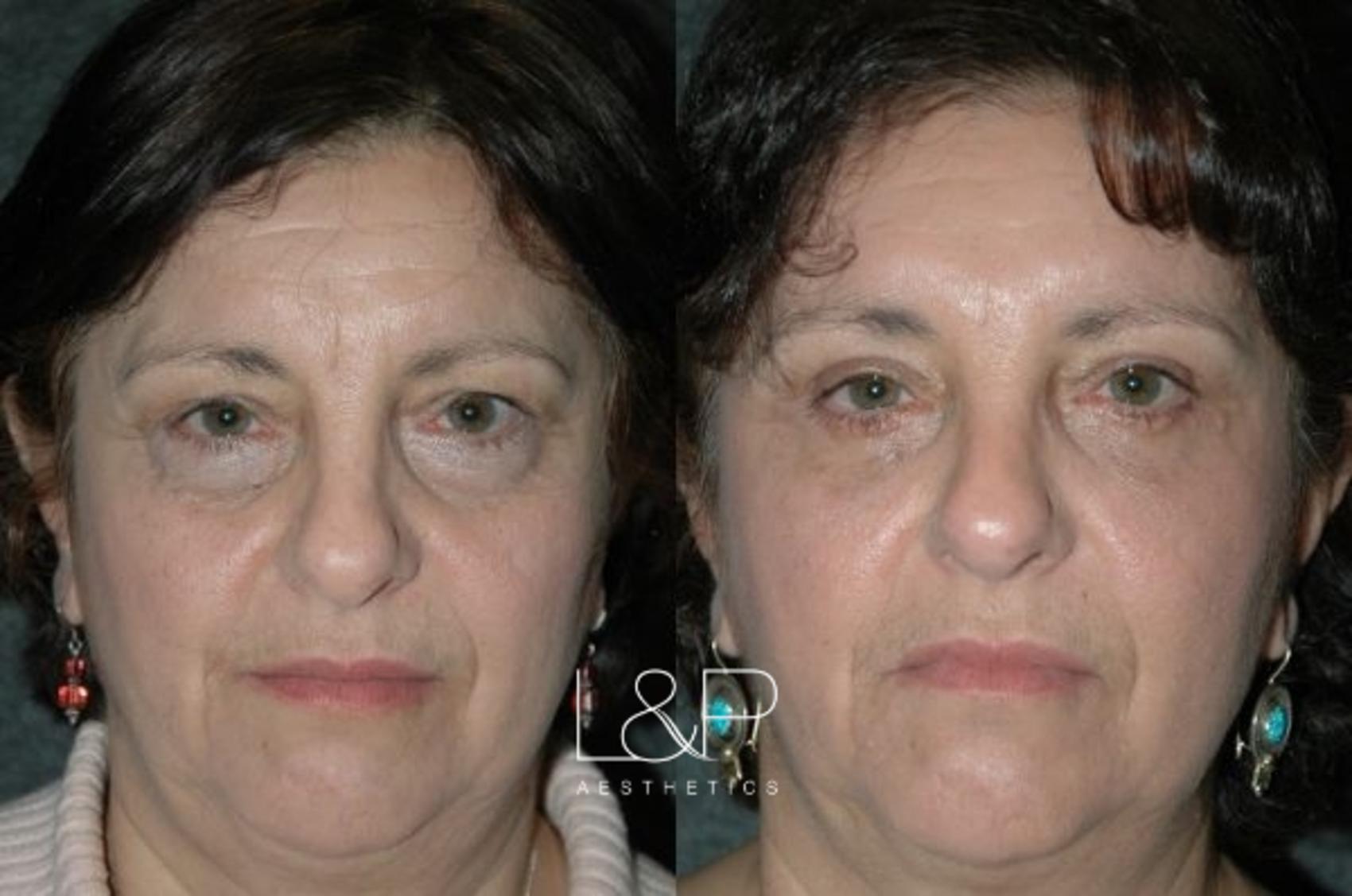 Before & After Blepharoplasty Case 12 Front View in Palo Alto & San Jose, California
