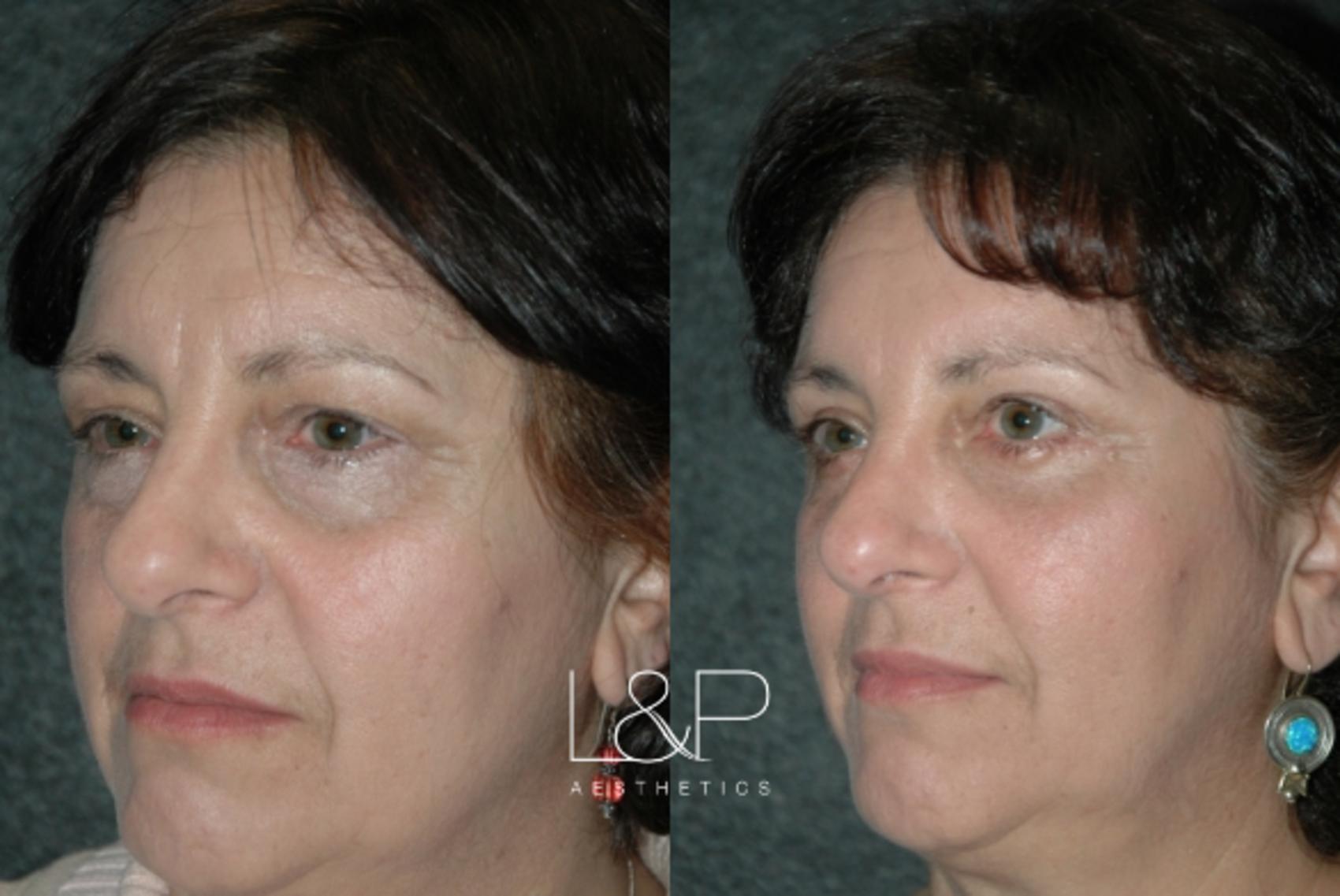 Before & After Blepharoplasty Case 12 Left Oblique View in Palo Alto & San Jose, California