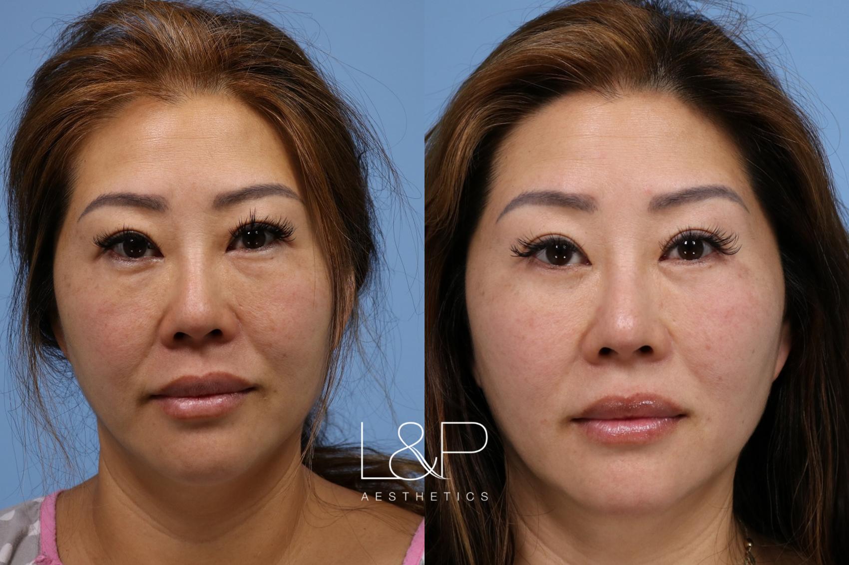 Before & After Photos Of A Blepharoplasty Procedure