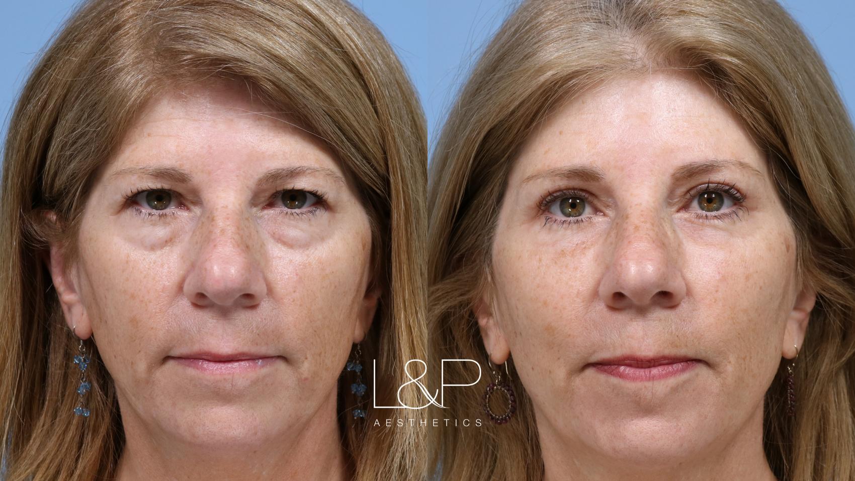 Upper & Lower Blepharoplasty with Brow Lift