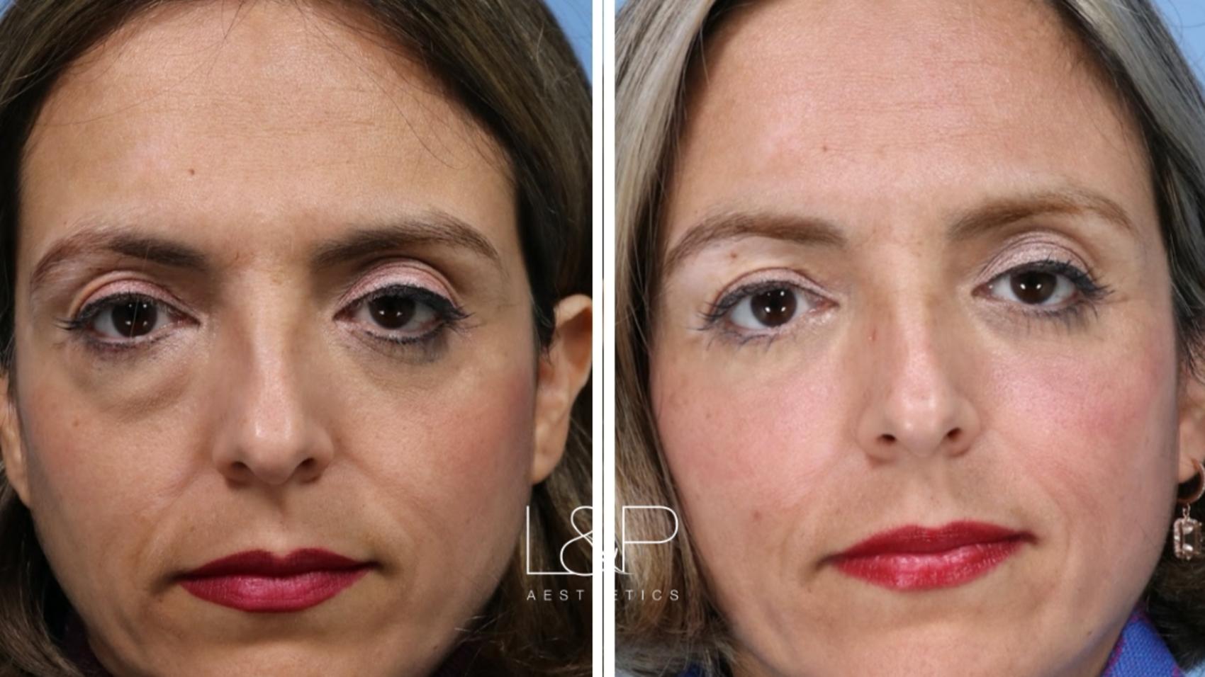 Drs Lieberman And Parikh Performed Lower Blepharoplasty For Bay Area Woman