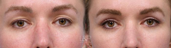 Drs Lieberman And Parikh Specialize In Several Facial Surgical Procedures Including Blepharoplasty