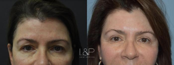 Before & After Blepharoplasty Case 7 Front View in Palo Alto & San Jose, California
