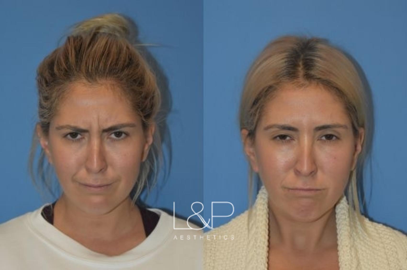 Before & After BOTOX® Cosmetic Case 100 Front View in Palo Alto & San Jose, California