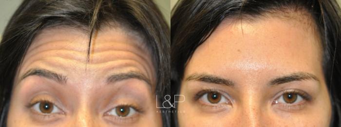 Before & After BOTOX® Cosmetic Case 101 Front View in Palo Alto & San Jose, California