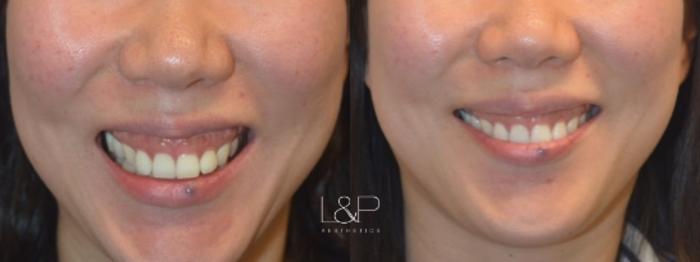Before & After BOTOX® Cosmetic Case 102 Front View in Palo Alto & San Jose, California