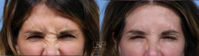 Before & After BOTOX® Cosmetic Case 166 Front  View in Palo Alto & San Jose, California