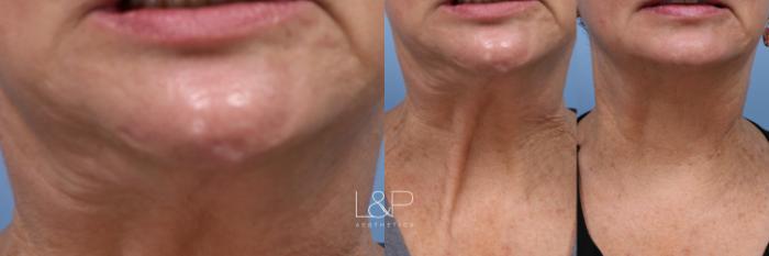 Botox targeted towards the neck lines that come with aging