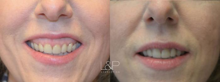 Before & After BOTOX® Cosmetic Case 99 Front View in Palo Alto & San Jose, California