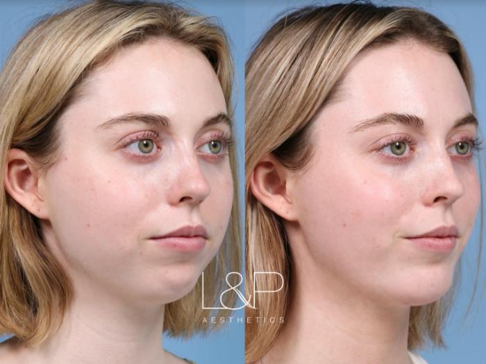 Before and After of college student that received a buccal fat reduction and chin implant. 