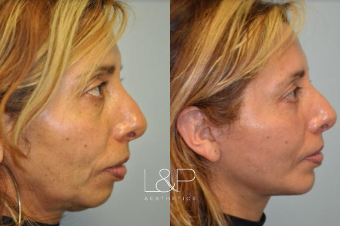 Chin Augmentation Before And After Photos Case 15 Palo Alto And San