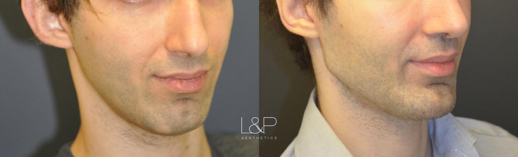 Obtain A Chiseled Look - Custom Jaw and Chin Implants — Plastic