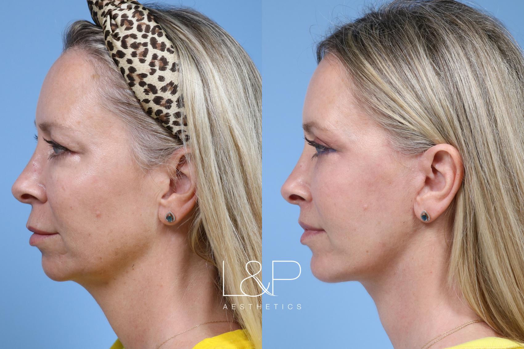 Chin Augmentation Before and After 