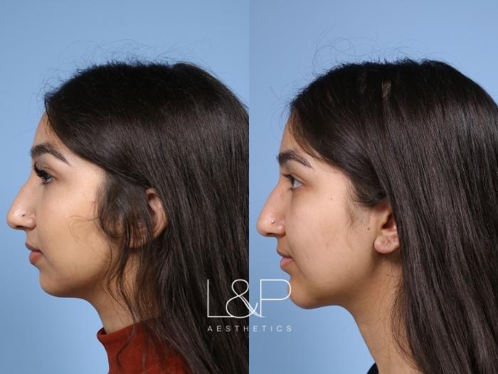 Jawline Contouring  Virginia, Washington D.C. and Maryland