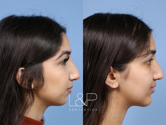 Chin augmentation to enhance the lower face