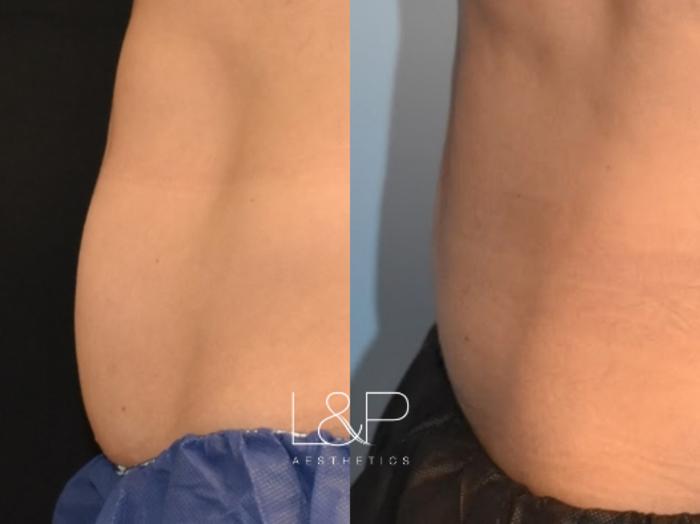 Before and After Coolsculpting 