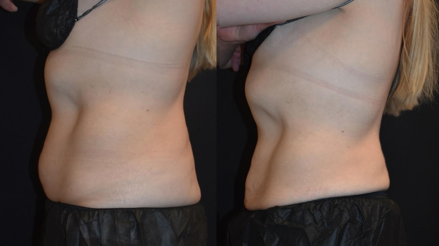 Woman receives coolsculpting treatment for her abdominal area