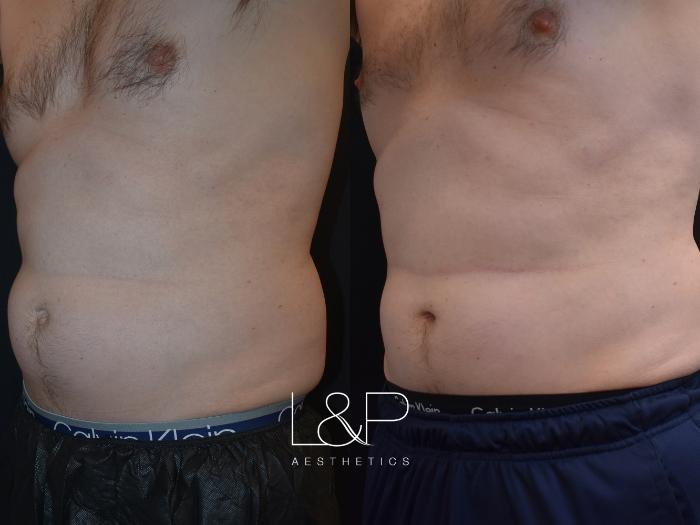 Male CoolSculpting