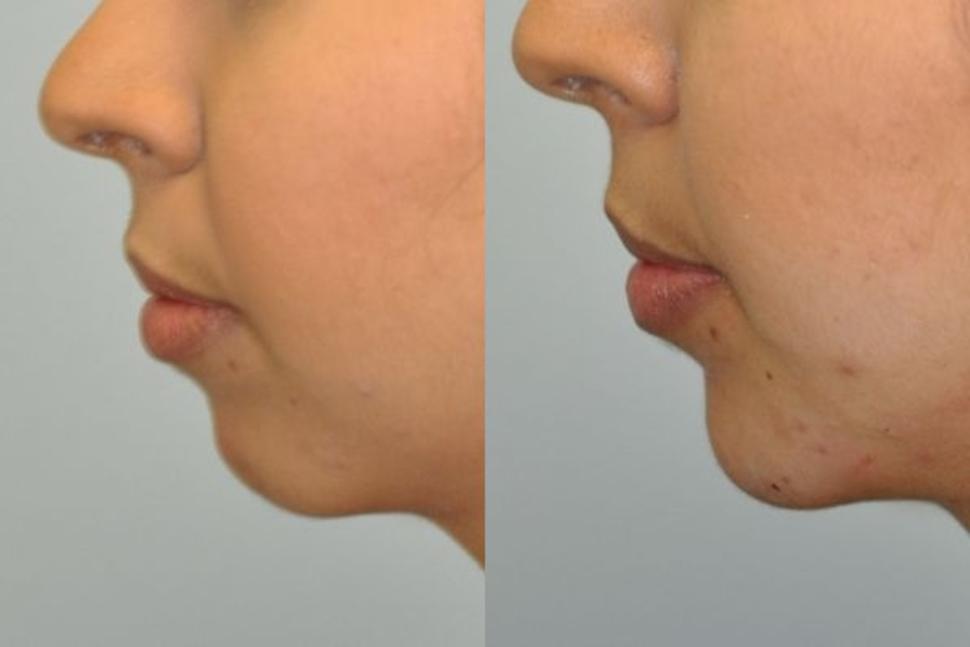 Before & After Facial Fillers Case 84 Left Side View in Palo Alto & San Jose, California