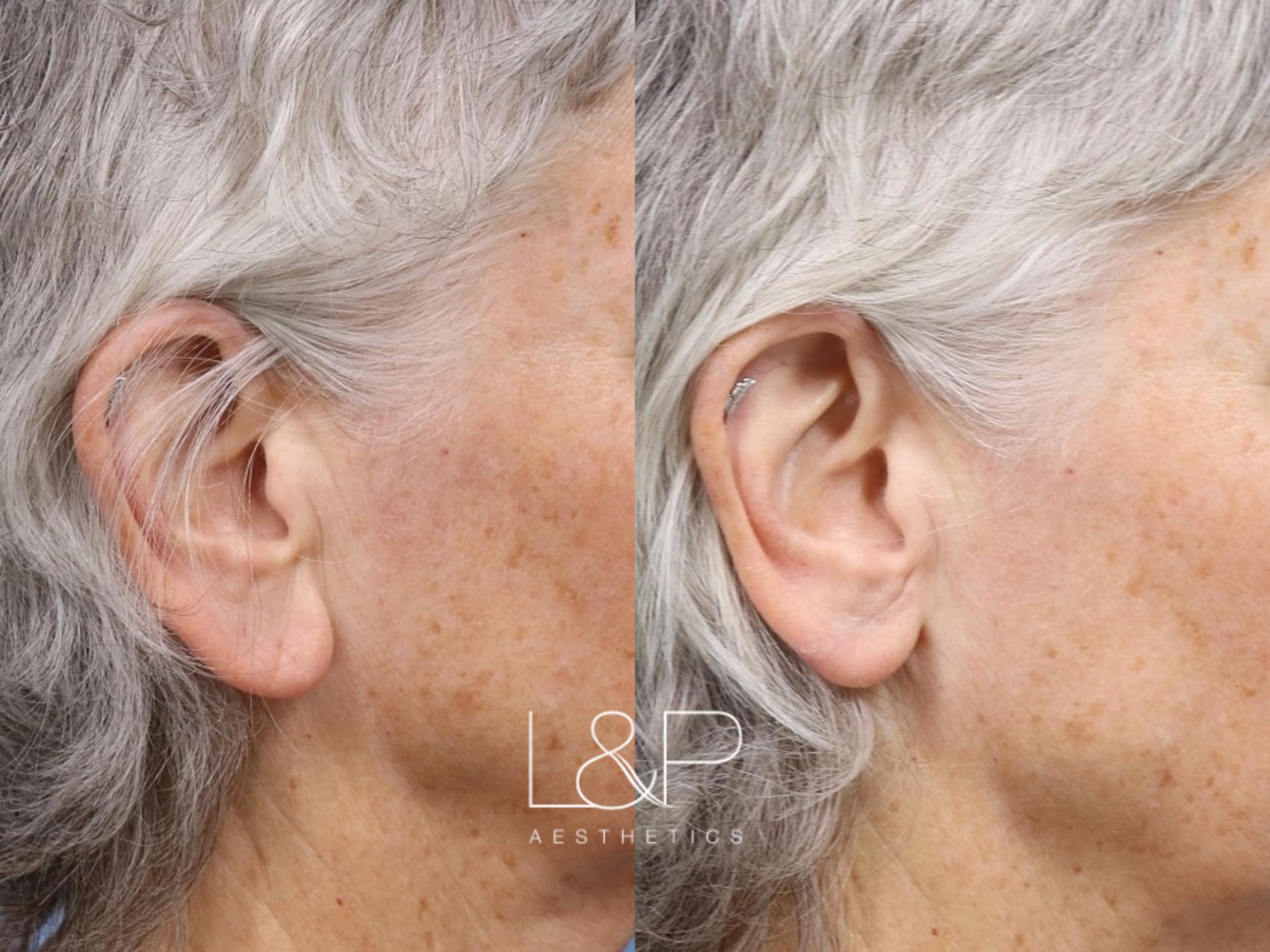 Earlobe Repair for Palo Alto, Los Gatos & San Jose