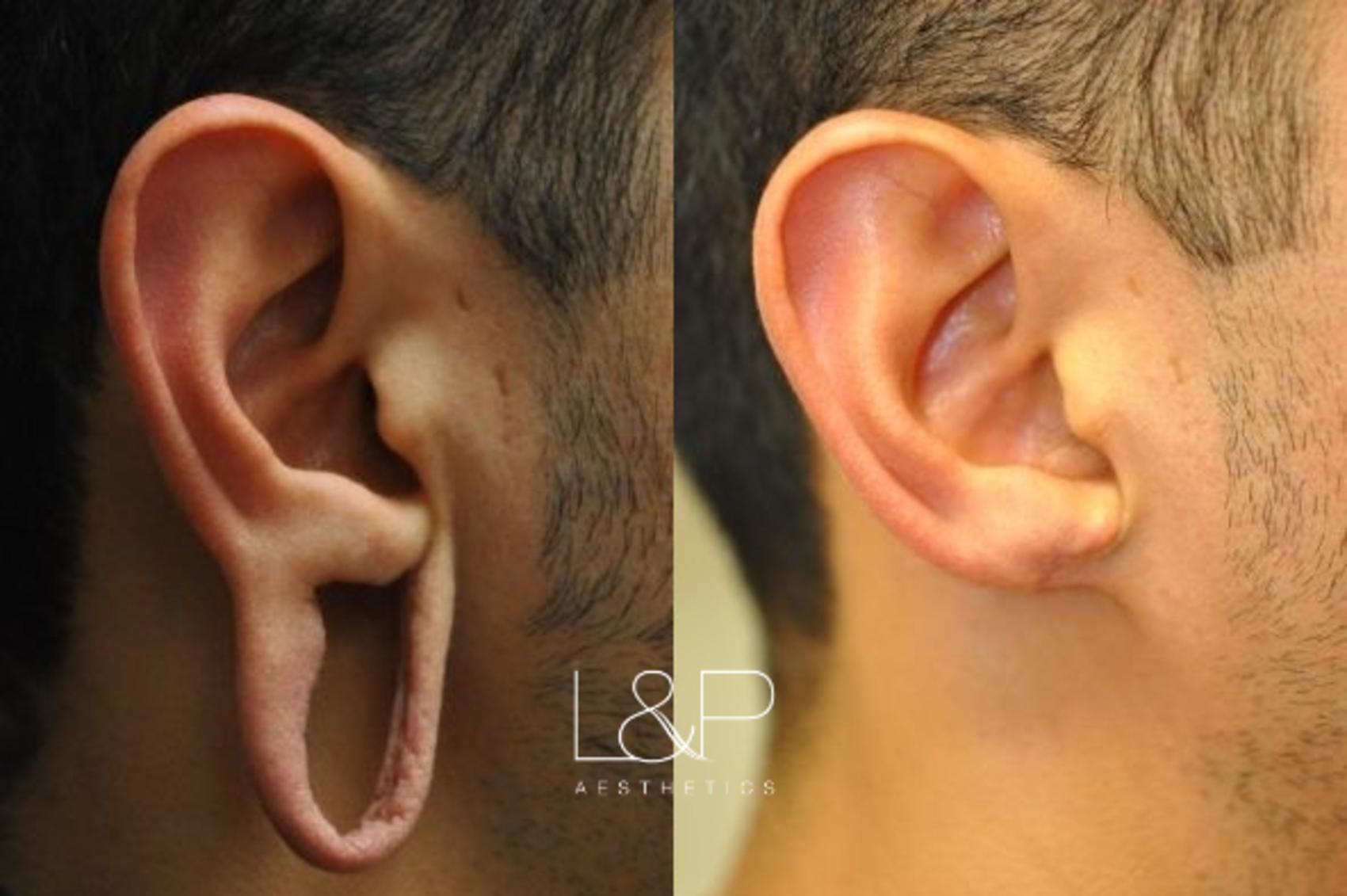 St. Petersburg & Clearwater Earlobe Repair