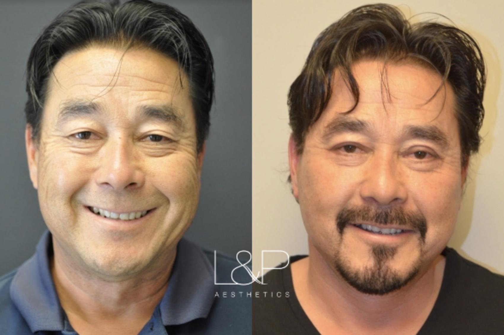 Before & After Facelift & Neck Lift Case 11 Front View in Palo Alto & San Jose, California