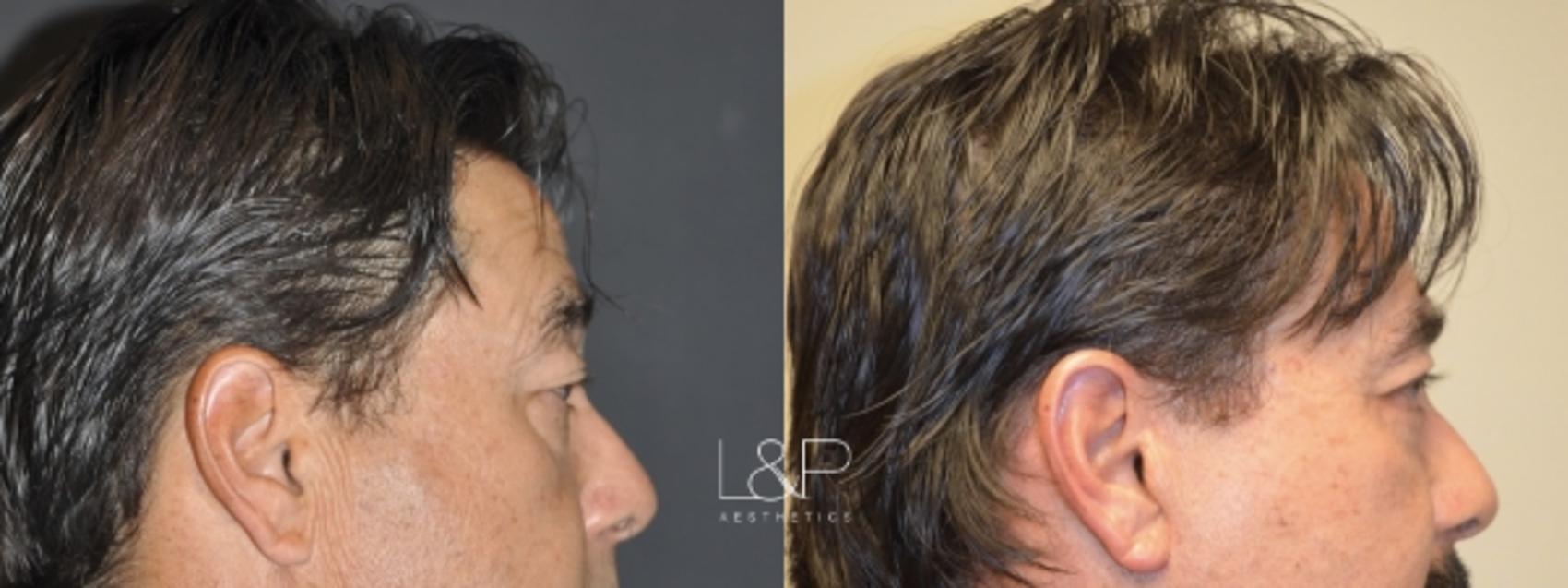 Before & After Facelift & Neck Lift Case 11 Right Side View in Palo Alto & San Jose, California