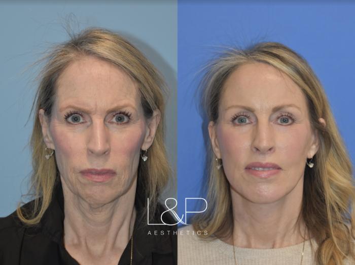 L&P Facelift and Neck Lift, Brow Lift, Fat Transfer, Chin Implant, Lip Lift & Laser Resurfacing 