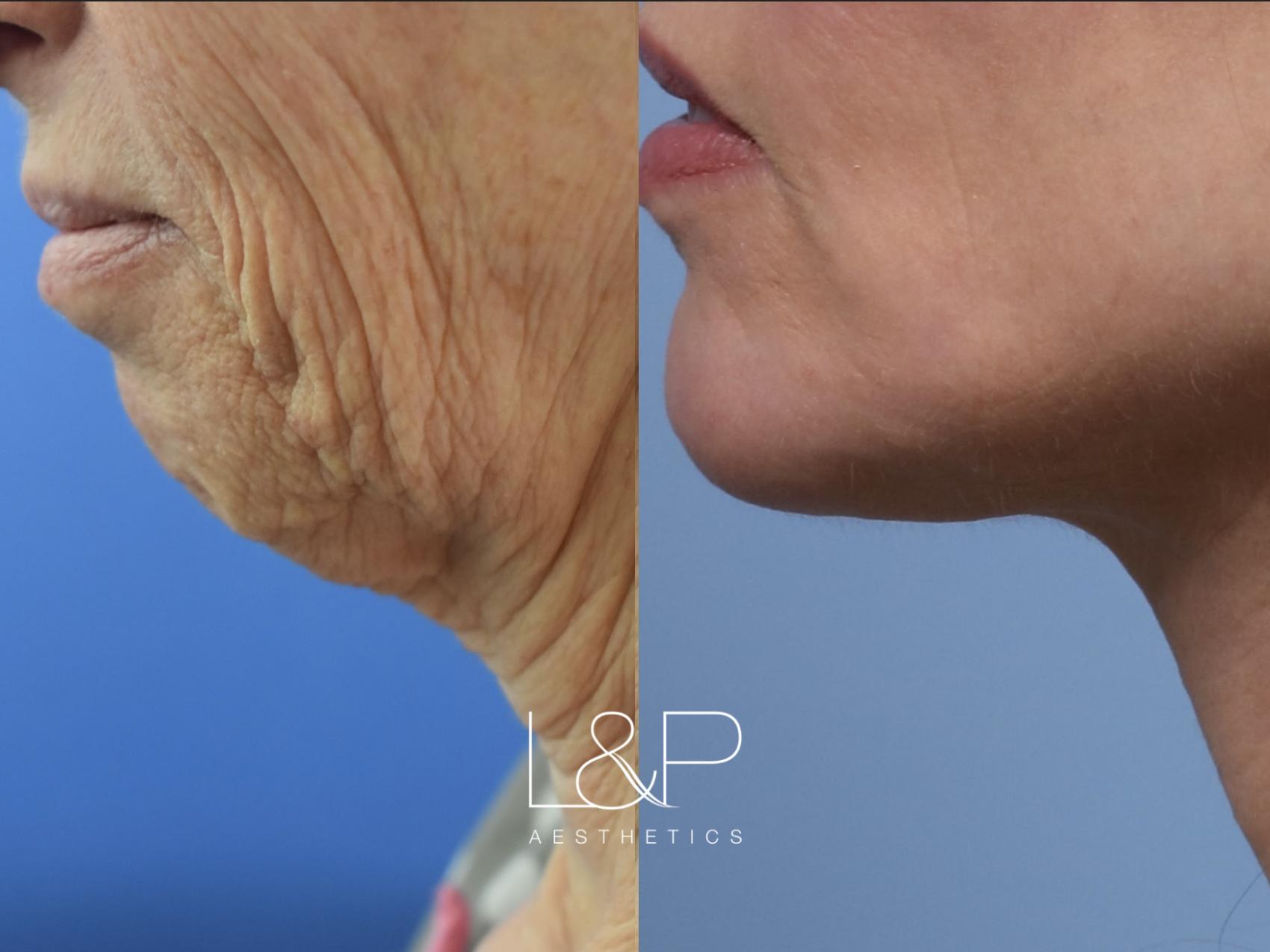 Before & After Lip Lift Case 115 Left Oblique View in Palo Alto & San Jose, California