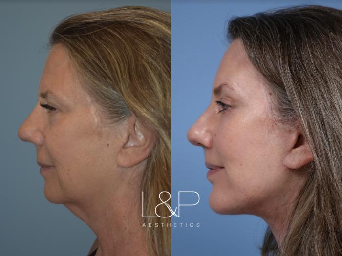 Before & After Facelift & Neck Lift Case 116 Left Side View in Palo Alto & San Jose, California