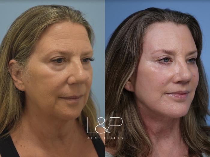 Before & After Facelift & Neck Lift Case 116 Right Oblique View in Palo Alto & San Jose, California