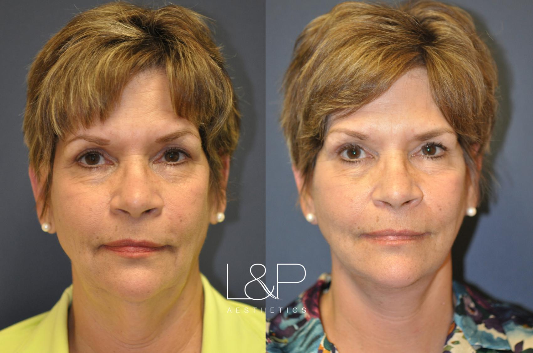 Deep Plane Facelift Before And After Photos