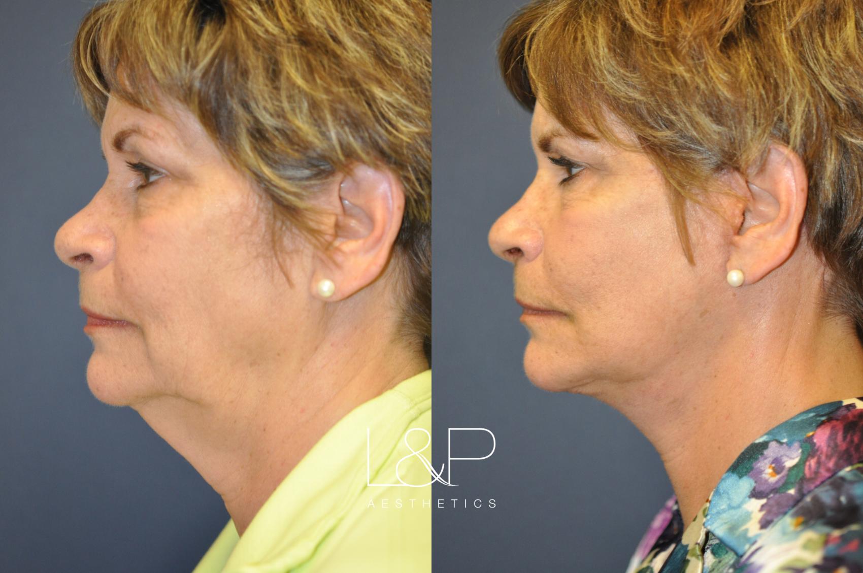 Deep Plane Facelift Before And After Photos