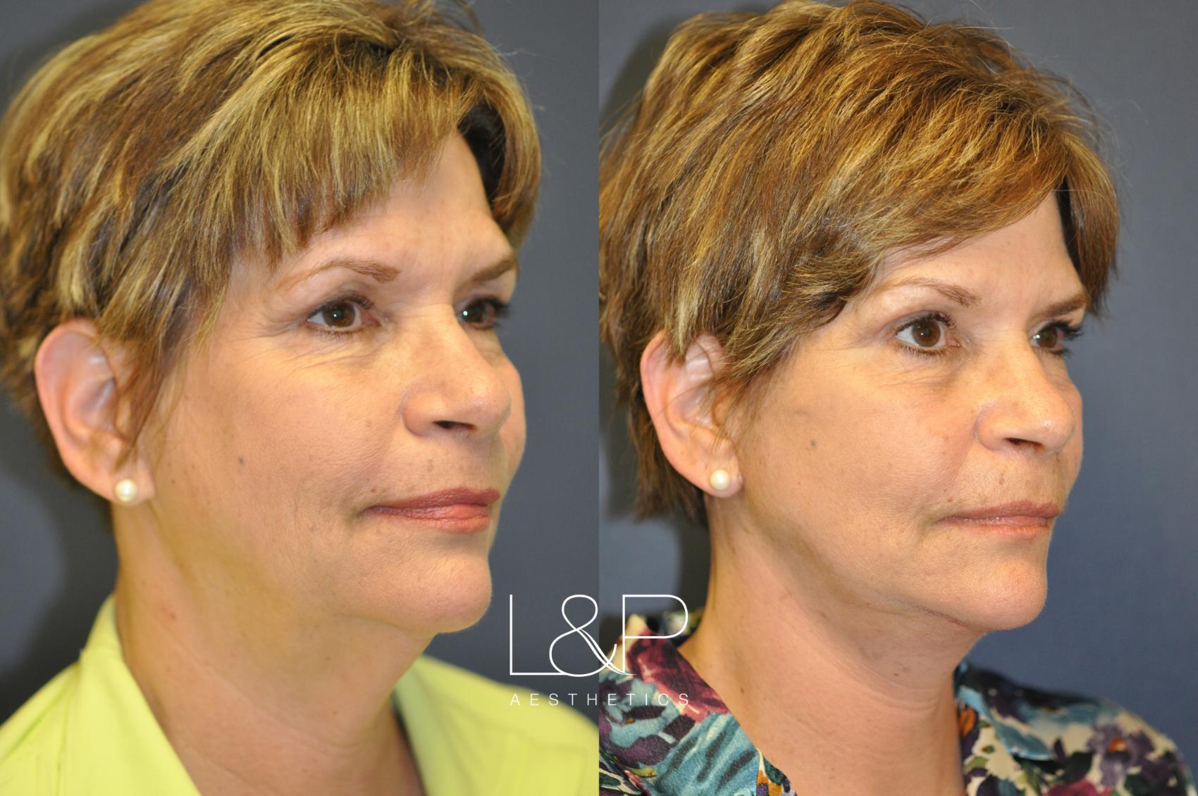 Deep Plane Facelift Before And After Photos