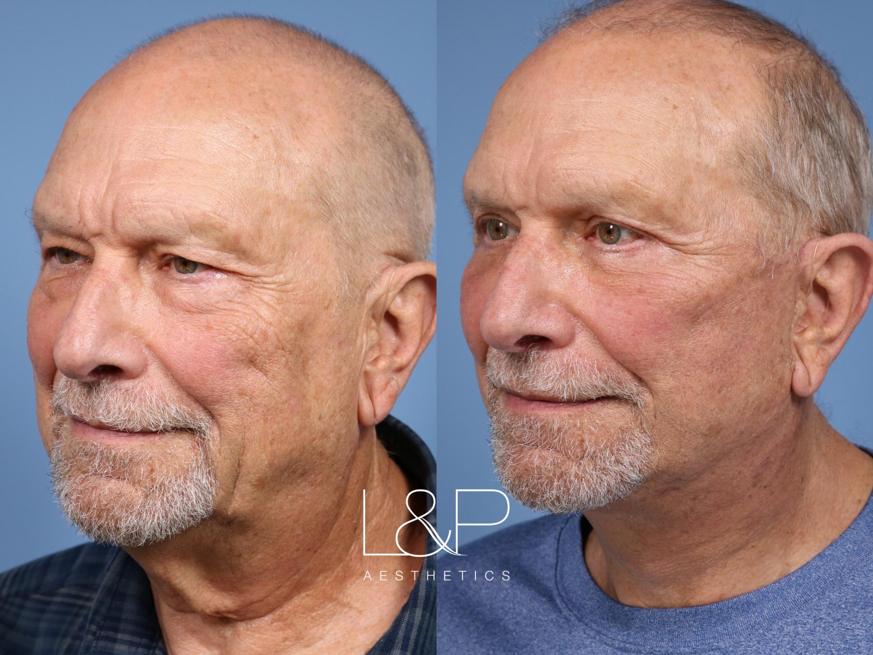 Before & After photos of a Male Facelift